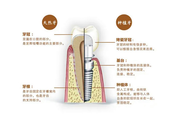 中年人种牙费用表2023(在口腔机构种植一颗牙得要多少钱价格)