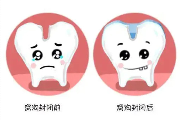 老年人上海九院种牙费用多少钱(大门牙补一个多少钱)