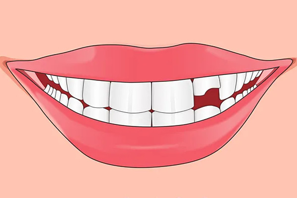 镶牙过程图解牙剩一半怎么补_镶牙过程图解牙剩一半怎么补好