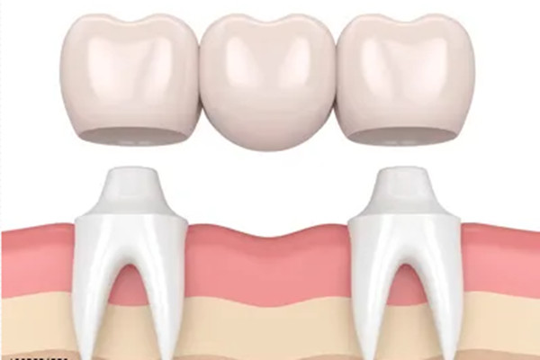 牙齿缺失的治疗方法有哪些种类(牙齿缺失的治疗方法有哪些种类